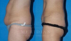 tjelmeland-meridian-austin-abdominoplasty-patient-16-2