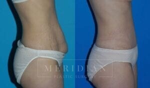 tjelmeland-meridian-austin-abdominoplasty-patient-17-2