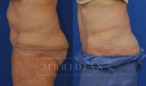 tjelmeland-meridian-austin-abdominoplasty-patient-20-2
