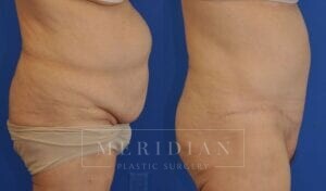 tjelmeland-meridian-austin-abdominoplasty-patient-22-2