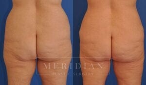 tjelmeland-meridian-austin-abdominoplasty-patient-24-2