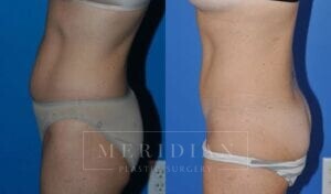 tjelmeland-meridian-austin-abdominoplasty-patient-4-2