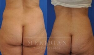 tjelmeland-meridian-austin-abdominoplasty-patient-6-3