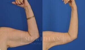 tjelmeland-meridian-austin-arm-lift-patient-4-1