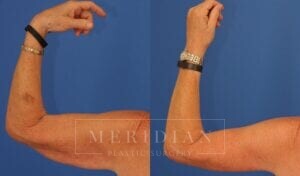 tjelmeland-meridian-austin-arm-lift-patient-5-2