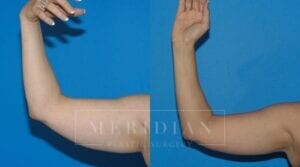 tjelmeland-meridian-austin-body-contouring-patient-19-1