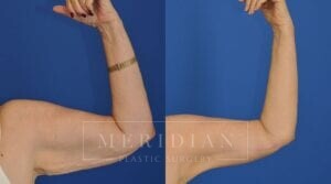 tjelmeland-meridian-austin-body-contouring-patient-21-1