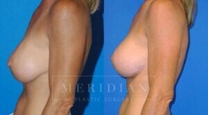 tjelmeland-meridian-austin-body-contouring-patient-25-2
