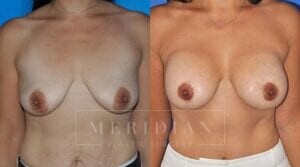 tjelmeland-meridian-austin-body-contouring-patient-27-1