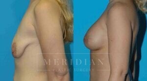 tjelmeland-meridian-austin-body-contouring-patient-29-2