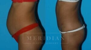 tjelmeland-meridian-austin-body-contouring-patient-3-3