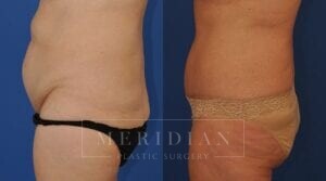 tjelmeland-meridian-austin-body-contouring-patient-30-3