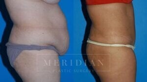 tjelmeland-meridian-austin-body-contouring-patient-4-2
