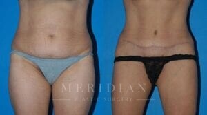 tjelmeland-meridian-austin-body-contouring-patient-6-1
