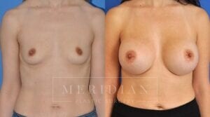 tjelmeland-meridian-austin-breast-augmentation-patient-10-1