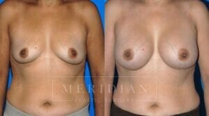 tjelmeland-meridian-austin-breast-augmentation-patient-11-1