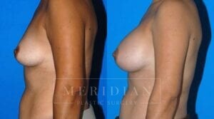 tjelmeland-meridian-austin-breast-augmentation-patient-11-2
