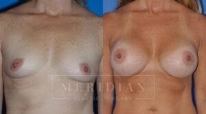 tjelmeland-meridian-austin-breast-augmentation-patient-12-1