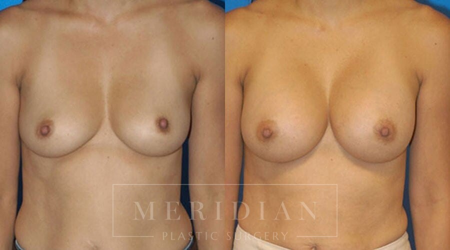 tjelmeland-meridian-austin-breast-augmentation-patient-13-1
