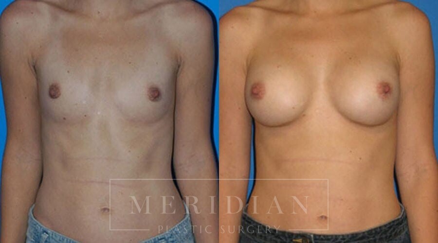 tjelmeland-meridian-austin-breast-augmentation-patient-14-1