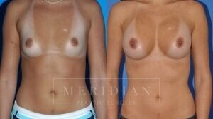 tjelmeland-meridian-austin-breast-augmentation-patient-16-1