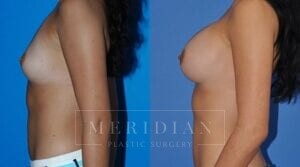 tjelmeland-meridian-austin-breast-augmentation-patient-16-2