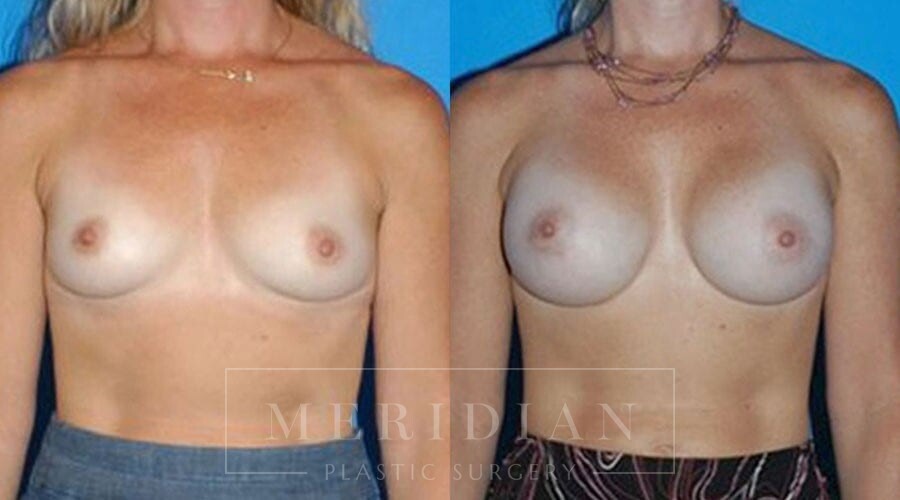 tjelmeland-meridian-austin-breast-augmentation-patient-17-1