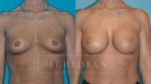 tjelmeland-meridian-austin-breast-augmentation-patient-18-1