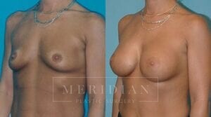 tjelmeland-meridian-austin-breast-augmentation-patient-18-2