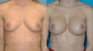 tjelmeland-meridian-austin-breast-augmentation-patient-19-1