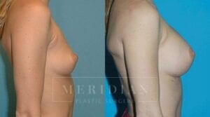 tjelmeland-meridian-austin-breast-augmentation-patient-19-2