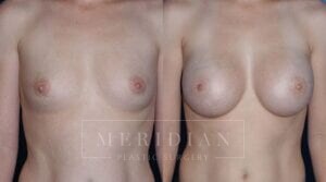 tjelmeland-meridian-austin-breast-augmentation-patient-2-1