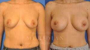 tjelmeland-meridian-austin-breast-augmentation-patient-20-1