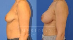 tjelmeland-meridian-austin-breast-augmentation-patient-20-2