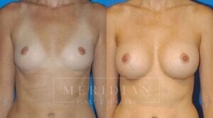 tjelmeland-meridian-austin-breast-augmentation-patient-21-1