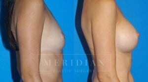 tjelmeland-meridian-austin-breast-augmentation-patient-21-2