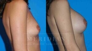 tjelmeland-meridian-austin-breast-augmentation-patient-22-2