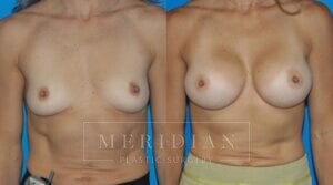 tjelmeland-meridian-austin-breast-augmentation-patient-23-1
