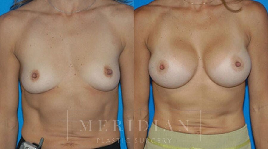 tjelmeland-meridian-austin-breast-augmentation-patient-23-1