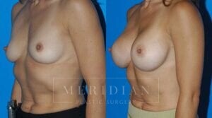 tjelmeland-meridian-austin-breast-augmentation-patient-23-2