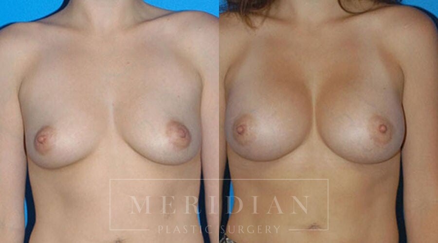 tjelmeland-meridian-austin-breast-augmentation-patient-24-1
