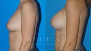tjelmeland-meridian-austin-breast-augmentation-patient-24-2