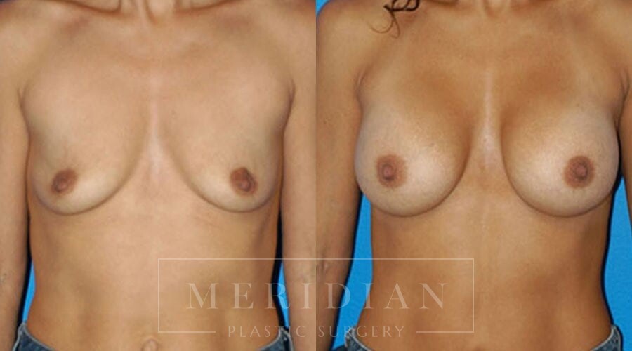 tjelmeland-meridian-austin-breast-augmentation-patient-25-1