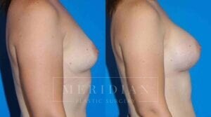 tjelmeland-meridian-austin-breast-augmentation-patient-26-2