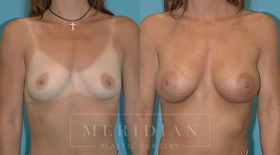 tjelmeland-meridian-austin-breast-augmentation-patient-27-1