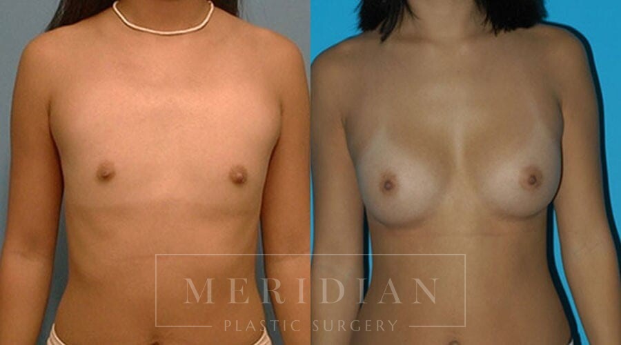 tjelmeland-meridian-austin-breast-augmentation-patient-28-1