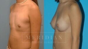 tjelmeland-meridian-austin-breast-augmentation-patient-28-2