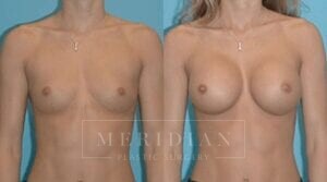 tjelmeland-meridian-austin-breast-augmentation-patient-29-1