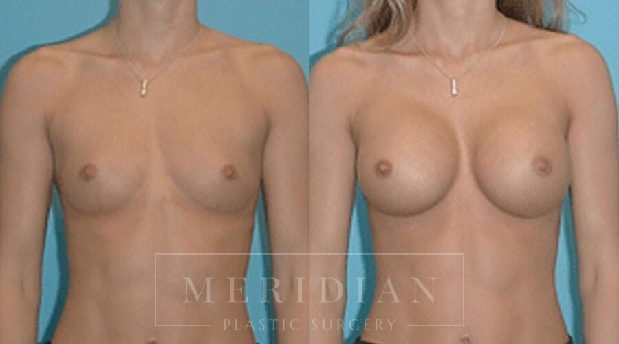 tjelmeland-meridian-austin-breast-augmentation-patient-29-1