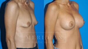 tjelmeland-meridian-austin-breast-augmentation-patient-30-2